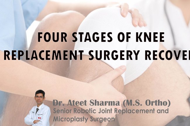 FOUR STAGES OF KNEE REPLACEMENT SURGERY RECOVERY